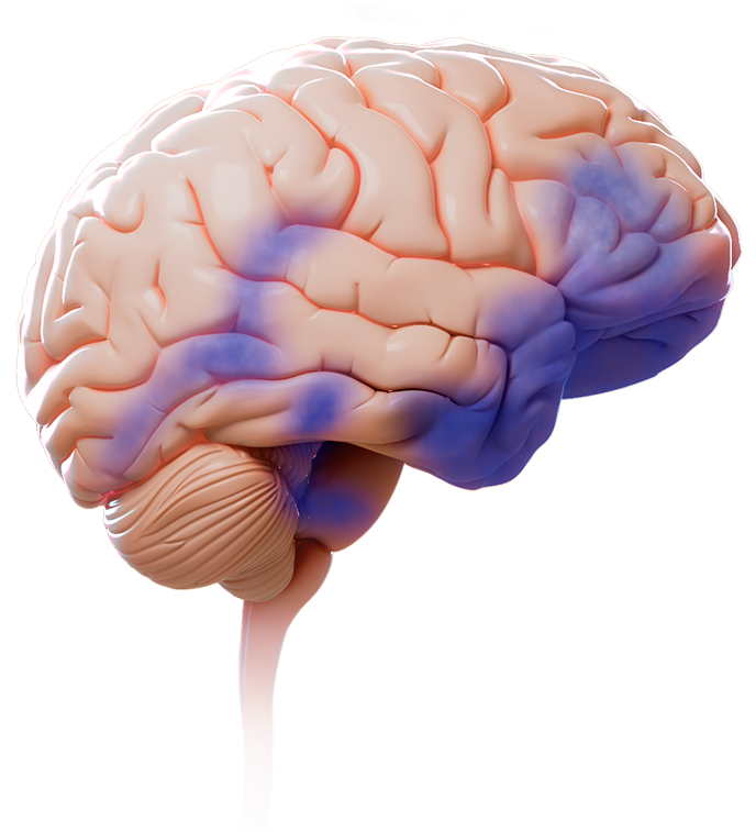 3D artistic representation of the human brain showing the side view of the cerebrum, cerebellum, and brainstem. A purple gradient highlights regions of the brain that may be affected during intermediate Alzheimer’s disease – e.g. the frontal lobe, hippocampus, retrosplenial cortex, entorhinal cortex, posterior parietal cortex, and temporal lobe.